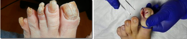 QU’EST-CE QUE LA PATHOLOGIE DES ONGLES ? CAUSES ET EFFETS 1 QU’EST-CE QUE LA PATHOLOGIE DES ONGLES ? CAUSES ET EFFETS