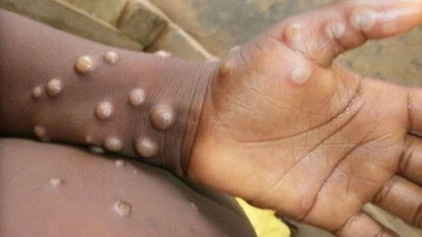 Avertissement médical : le Monkeypox est hors de contrôle