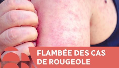 une flambée dramatique de rougeole au Maroc: défaillances structurelles ou responsabilité collective?