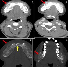 Tumeur brune de la mandibule : une équipe marocaine à l’honneur dans le Jordan Journal of Dentistry